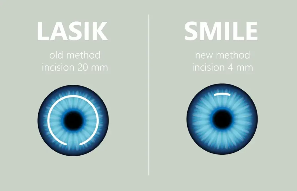 Diagram comparing the larger LASIK incision with the small SMILE opening